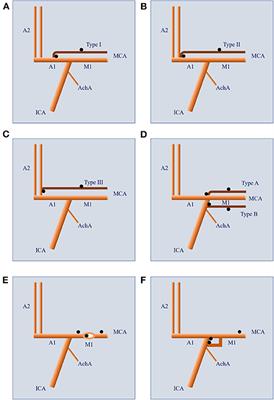 The Clinical Characteristics and Treatment Considerations for Intracranial Aneurysms Associated With Middle Cerebral Artery Anomalies: A Systematic Review